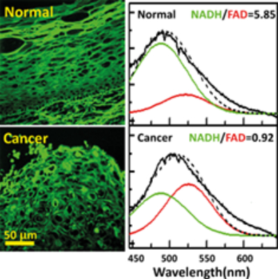 Non-invasive Cervical Cancer Detection Through Fluorescence Spectroscopy