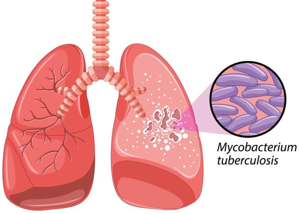 The Future of TB Diagnosis in India - Affordable and Accessible POC Testing