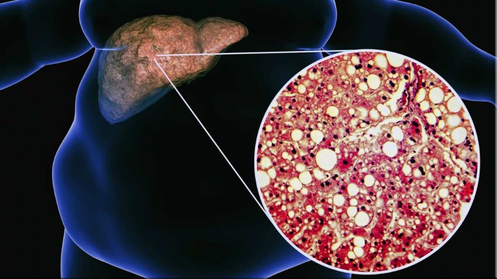 Fatty Liver and Hepatitis - The Silent Epidemics India Must Tackle Now