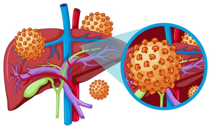 Prioritizing Hepatitis Diagnosis and Access Can Help Fight the Epidemic