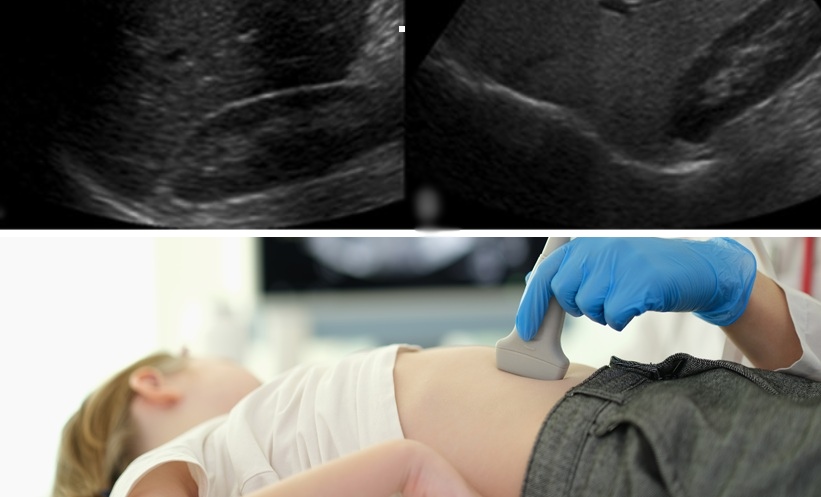 Paediatric Hepatitis Requires Urgent Action - Timely Screening Can Save Young Lives